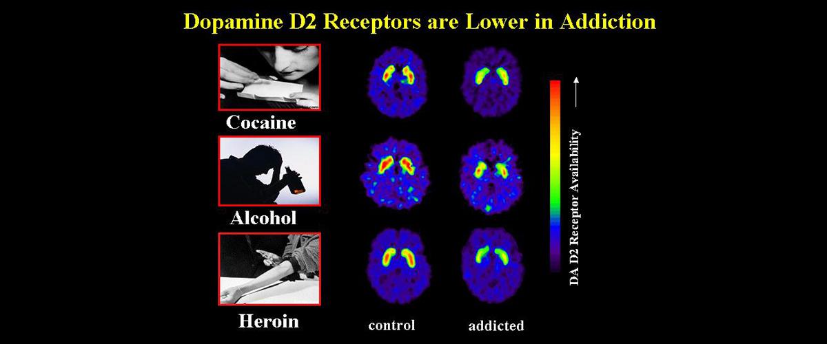 A graphic demonstrating dopamine levels in cocaine, alcohol, and heroin addiction